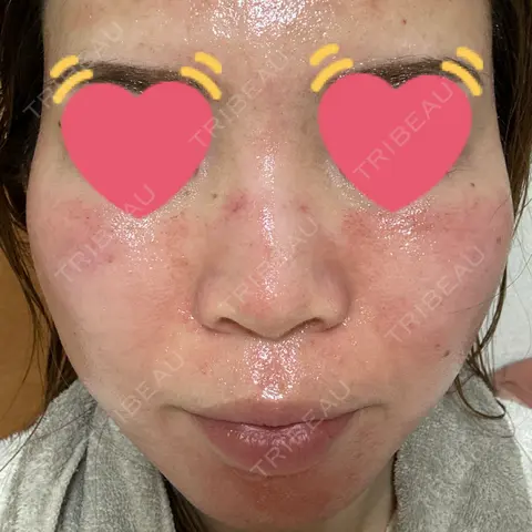 ヴェルヴェットスキン ブリリアスキンクリニック DAY 0