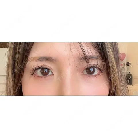 目尻切開 / タレ目形成・グラマラスライン（埋没） LOUIS CLINIC 二子玉川院【ルイクリニック】 AFTER