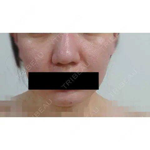 肌ヒアルロン酸注入（たるみ・シワ改善） A CLINIC（エークリニック） 福岡院 AFTER