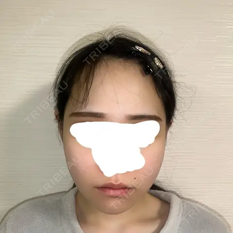 骨切り（あご） / 骨削り（エラ） / 骨削り（頬） セギム美容整形外科 DAY 29