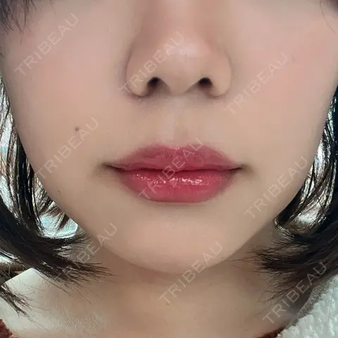 ヒアルロン酸注入（鼻） / ヒアルロン酸注入（唇） / ボトックス（口角） THE FIRST CLINIC 多摩センター院 DAY 2