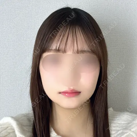 骨切り（あご） / 骨削り（エラ） / 骨削り（頬） / バッカルファット除去 / 脂肪吸引（顔） バタン美容整形外科 DAY 28