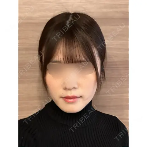 糸リフト / バッカルファット除去 / ジョールファット除去 / ボトックス（エラ・小顔） BLINC CLINIC （ブリンク クリニック） AFTER