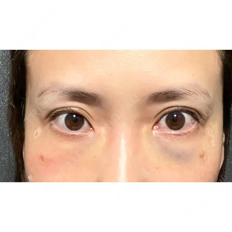 クマ治療 X CLINIC 銀座院 DAY 0