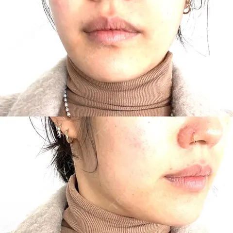 ボトックス（エラ・小顔） / ボトックス（肩） / シワ取りボトックス / ボトックス（首） THE FIRST CLINIC 多摩センター院 AFTER