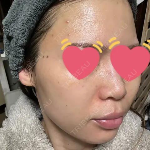 ヴェルヴェットスキン ブリリアスキンクリニック AFTER