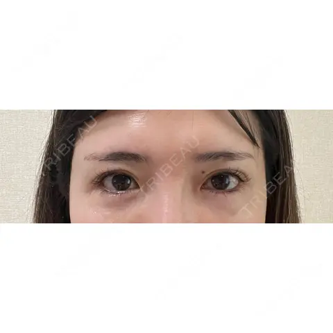 目尻切開 / タレ目形成・グラマラスライン（埋没） LOUIS CLINIC 二子玉川院【ルイクリニック】 AFTER