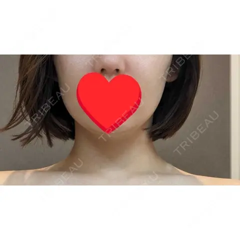 ヒアルロン酸注入（あご） / ボトックス（エラ・小顔） / ボトックス（肩） / ボトックス（首） / ヒアルロン酸注入（鼻翼基部） L‘amour clinic Tokyo【ラムールクリニック東京】 AFTER