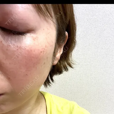 イオン導入 / ルメッカ ルラ美容クリニック 大宮院 DAY 0