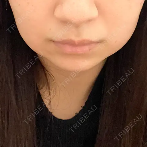 脂肪溶解注射（顔） あいち栄クリニック DAY 0