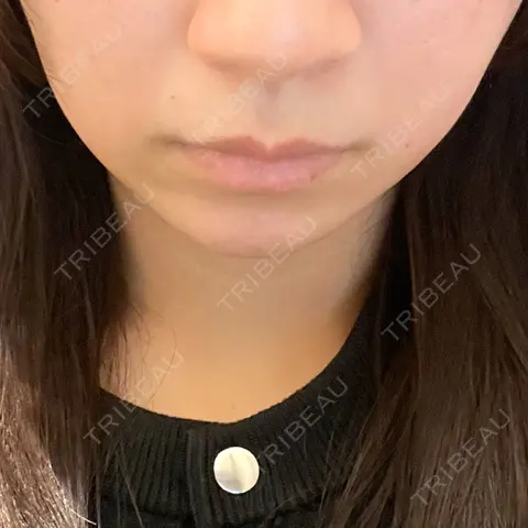 脂肪溶解注射（顔） あいち栄クリニック AFTER