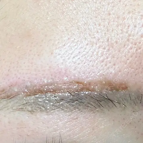 アートメイク（傷跡修正） LEAGRANT CLINIC 中目黒 AFTER