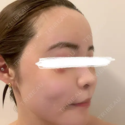 脂肪注入（肌） / 脂肪注入（目の下） / その他（口元） X CLINIC 恵比寿院 AFTER