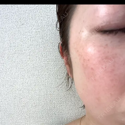 イオン導入 / ルメッカ ルラ美容クリニック 大宮院 AFTER