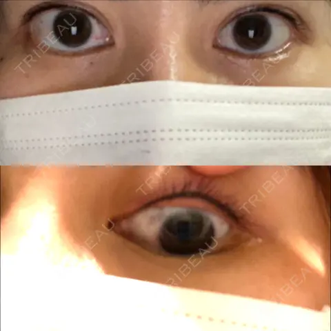 アートメイク（アイライン） Kinshicho Beauty Clinic （錦糸町ビューティークリニック） DAY 0