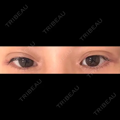目頭切開 / クマ治療 / 目尻切開 / タレ目形成・グラマラスライン（切開） 銀座TAクリニック AFTER