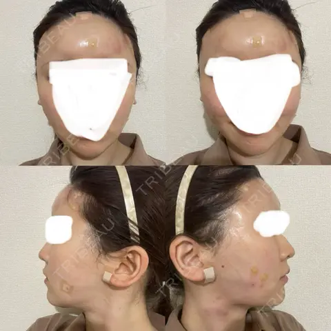 ほくろ・いぼ切除（肌） / 脂肪吸引（顔） / 額を丸く / 脂肪注入（肌） / 脂肪注入（額） 東京美専クリニック DAY 0