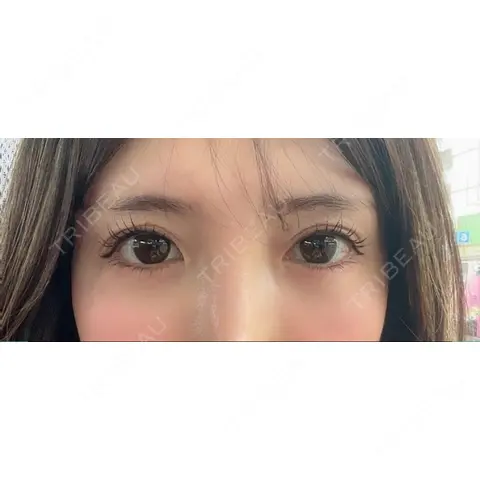 目尻切開 / タレ目形成・グラマラスライン（埋没） LOUIS CLINIC 二子玉川院【ルイクリニック】 AFTER