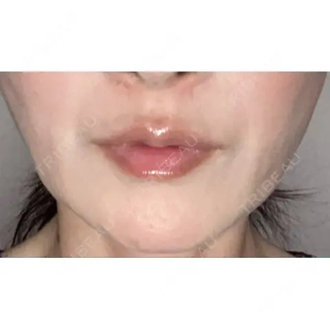 糸リフト / 脂肪吸引（顔） RIVER CLINIC（リバークリニック） AFTER