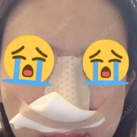 鼻尖形成（切開） / 鼻中隔延長（切開） / 小鼻縮小（切開） HANABI整形外科 DAY 0