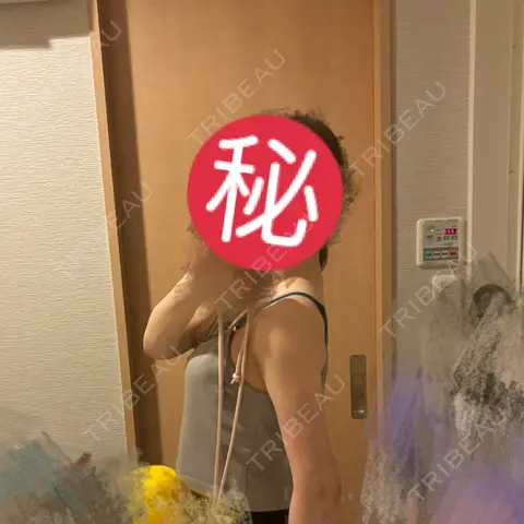 脂肪吸引（二の腕） / インディバ（二の腕） Casa de GRACIA GINZA 【カーサデグラシアギンザ】 AFTER
