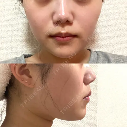 糸リフト / 脂肪吸引（顔） / ボトックス（エラ・小顔） RIVER CLINIC（リバークリニック） AFTER