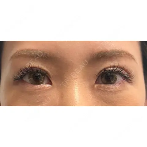 二重埋没 NARU Beauty Clinic 【ナルクリ】 DAY 3