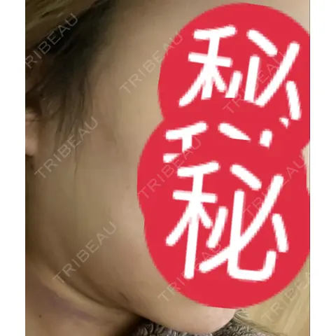 糸リフト / 脂肪吸引（顔） / ヒアルロン酸注入（唇） ヴェルトラクリニック 大阪院 DAY 1