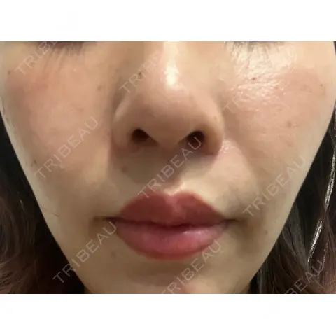 小鼻縮小（切開） / 人中短縮 / 鼻翼挙上 Otus Clinic 【オータスクリニック】 AFTER