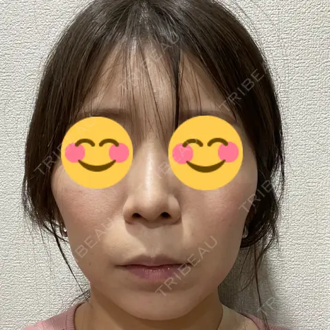 ボトックス（エラ・小顔） KARIS beauty clinic AFTER