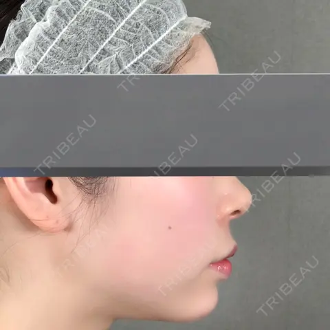 ヒアルロン酸注入（あご） アリエル美容クリニック 大宮院 AFTER