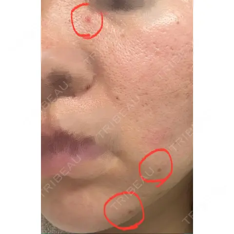 ほくろ・いぼ除去レーザー（肌） Mavie Beauty Clinic （マヴィービューティークリニック） DAY 1