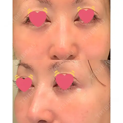 クマ治療 / 下まぶたたるみ取り / 脂肪注入（目の下） / ヒアルロン酸溶解 X CLINIC 大阪院 AFTER