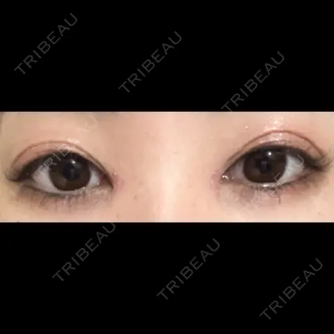 目頭切開 アリエル美容クリニック 郡山院 AFTER