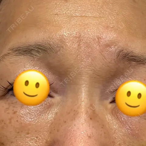 クマ治療 / ヒアルロン酸注入（目の下） / ボトックス（額） AI Beauty Clinic （エーアイ美容クリニック） DAY 0