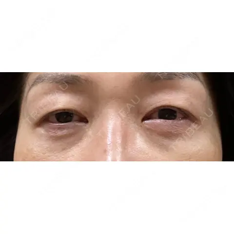 クマ治療 / 上まぶたの脂肪取り AI Beauty Clinic （エーアイ美容クリニック） DAY 0
