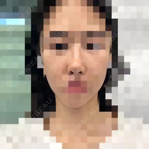 小鼻縮小（切開） / 骨切り（あご） / 骨削り（エラ） / 骨削り（頬） / 骨切幅寄せ / 輪郭修正 セギム美容整形外科 DAY 34