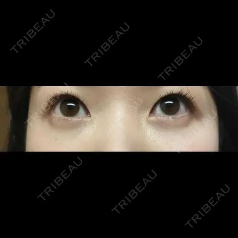 クマ治療 / その他（目元） EMMO FACE CLINIC 大宮院 AFTER