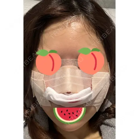 鼻尖形成（切開） / 骨削り（頬） / 軟骨移植 / 鼻孔縁挙上 THE ROPPONGI CLINIC（ザ 六本木クリニック） DAY 0