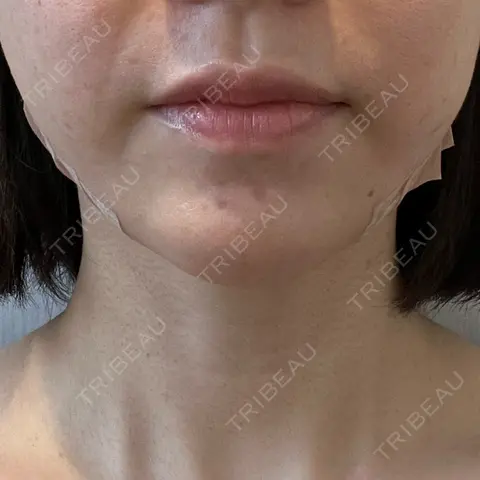 糸リフト 横浜TAクリニック AFTER
