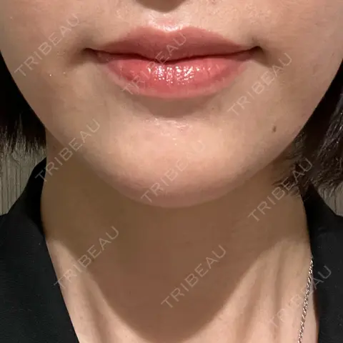 糸リフト 横浜TAクリニック AFTER
