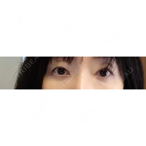 クマ治療 / スネコス TCB東京中央美容外科 倉敷院 AFTER