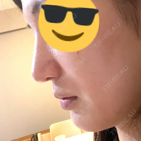鼻中隔延長（切開） / 小鼻縮小（切開） / 軟骨移植 / 骨切幅寄せ / ワシ鼻修正・ハンプ切除 / その他（鼻） THE ROPPONGI CLINIC（ザ 六本木クリニック） AFTER