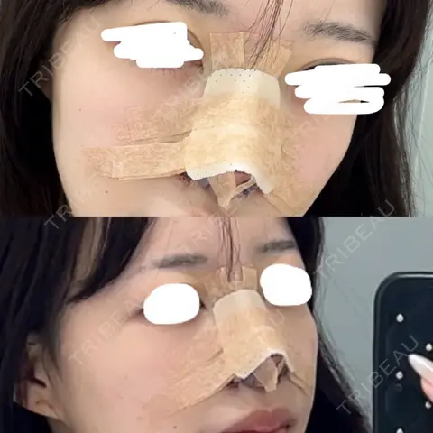 鼻尖形成（切開） / 鼻中隔延長（切開） / 小鼻縮小（切開） / 軟骨移植 / 眉間プロテーゼ グローバルビューティークリニック 銀座院 DAY 0