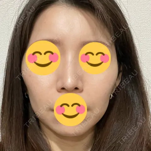 ボトックス（エラ・小顔） KARIS beauty clinic AFTER