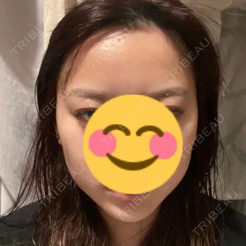 ボトックス（エラ・小顔） KARIS beauty clinic AFTER