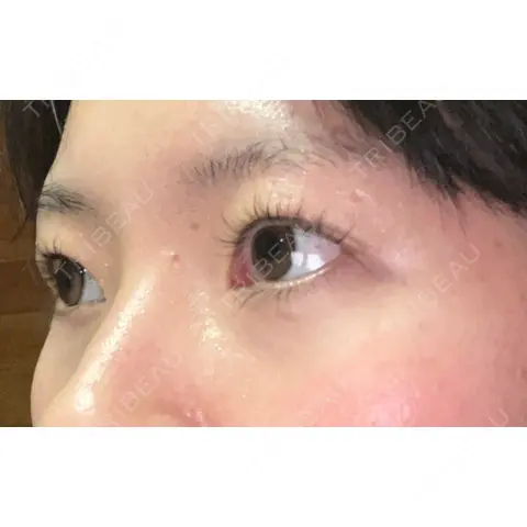 下まぶたの脂肪取り Brandnew Beauty Clinic AFTER