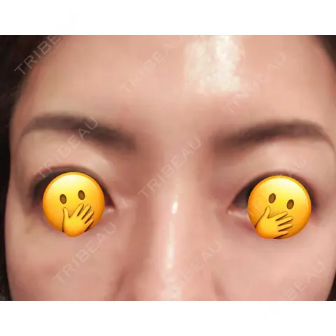 ヒアルロン酸注入（涙袋） EMMO FACE CLINIC 大宮院 DAY 1