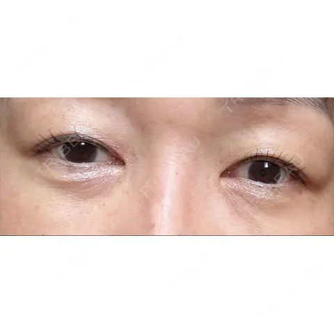 クマ治療 / 上まぶたの脂肪取り AI Beauty Clinic （エーアイ美容クリニック） AFTER