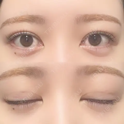 二重埋没 / 上まぶたの脂肪取り 9BeautyClinic AFTER